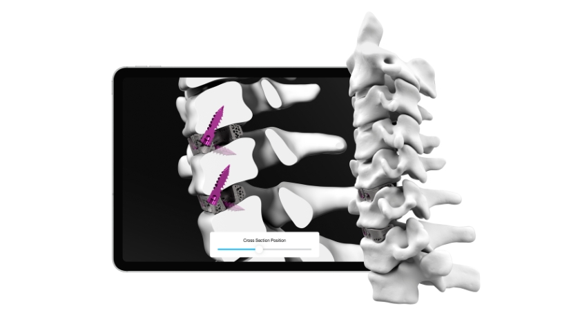 Carlsmed Launches aprevo Personalized Cervical Fusion Platform in U.S.